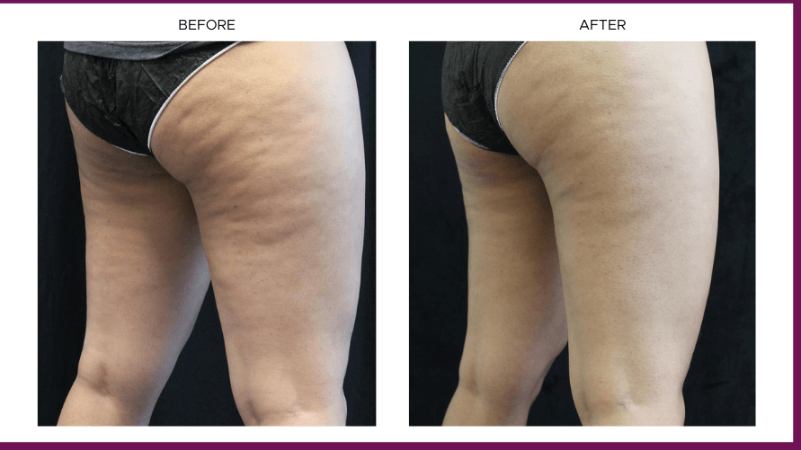 Sculptra treatment for celluli